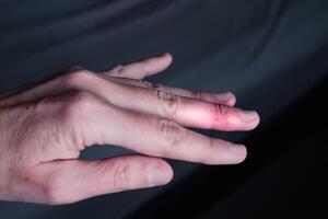 Mallet finger healing after splint removal from middle finger following joint trauma photo