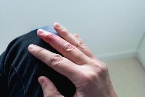 Mallet finger healing after splint removal from middle finger following joint trauma photo