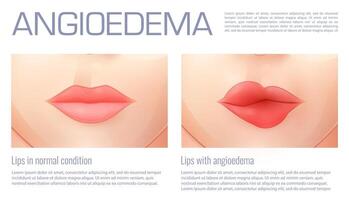 Swollen lips from angioedema or edema swelling vector