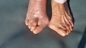 Unique Look at a Foot Condition Highlighting Hallux Valgus standing on exercise mat video