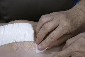 plaster waterproof close the wound for protech long scar and gash bruise on leg after surgery knee arthroplasty osteoarthritis. old retirement women patient recovery skin using alcohol pad photo