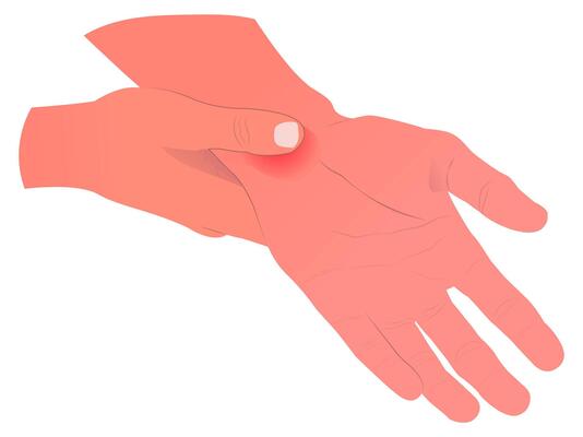 illustration of a sore wrist, suitable for medical professionals, or designers. suitable for use in brochures, infographics, websites, or social media posts.