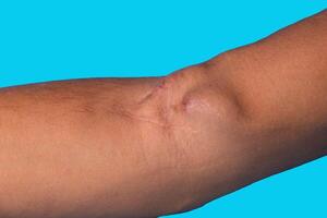 Fistula on the arm as a result of an operation for hemodialysis with kidney failure. photo