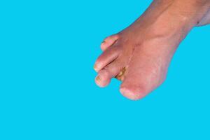 Amputation of diabetic toes of a person on a blue background. Selective focus. photo