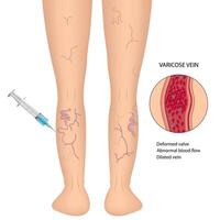 clerotherapy surgery is a medical procedure for treating varicose veins and cardiovascular spider veins. Injection of a solution into a vein vector