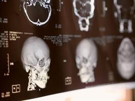 MRI of the human brain of a patient with multiple sclerosis of the initial stage. Close-up X-ray photo