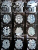 MRI of the human brain of a patient with multiple sclerosis of the initial stage. Close-up X-ray vertical photo