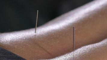 Acupuncture needles in the back of a woman in a acupuncture session video