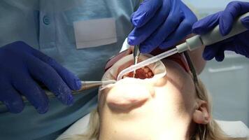 Dentist hands carefully use drill carefully working in opened jaw of patient. Person undergoes dental treatment procedure in private clinic video