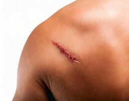close-up of a fresh scar from a minor healed cut on the shoulder isolated on white background photo