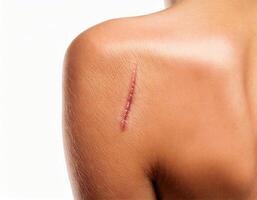 close-up of a healed scar from a cut on the shoulder with smooth skin texture isolated on white background photo