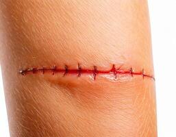 close-up of a surgical incision with fresh stitches on skin isolated on white background photo