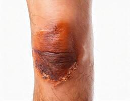 third-degree burn on the lower leg with visible scarring and discoloration isolated on white background photo