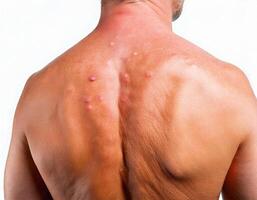 close-up of irritated skin with a cluster of heat blisters and redness on a male back isolated on white background photo
