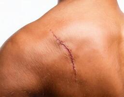close-up of a fresh scar from a healed cut on the shoulder with visible stitches isolated on white background photo