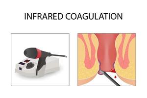 Medical instruments, healthcare for hemorrhoids vector