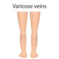 Human Legs with Health Problems. Varicose Veins vector