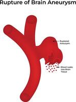 Rupture of Brain Aneurysm Science Design Illustration Diagram vector