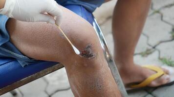 In this image, healthcare professional is cleaning wound on person knee, showcasing importance of proper wound care and hygiene photo