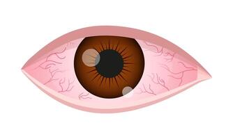 Dry eye syndrome. Inflamed bloodshot eyeball with swelling, irritation and red conjunctiva. Symptoms of infection, allergy, keratitis, blepharitis, conjunctivitis, uveitis vector