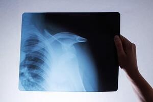 A woman's hand holds an x-ray of a patient with a dislocated shoulder and a fractured collarbone, osteoporosis. Surgery to reconstruct the shoulder joint, radiography photo