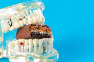 A bitten piece of chocolate in a dental jaw mockup on a blue background. The concept of the effect of sugar and leftover food on teeth and tooth enamel. Tooth destruction by bacteria, caries photo