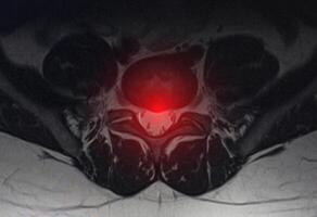 Image after examination of magnetic resonance imaging. Spine examination concept, degenerative changes in the intervertebral discs, spondylarthrosis, protrusion photo