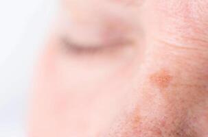 age spots on the face of a woman with dry skin and wrinkles, background, macro, problem photo