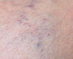 Vascular asterisk on the patient s skin. The concept of varicose veins in humans, background, macro, phlebeurysm photo
