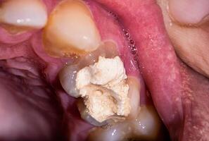 Tooth filling with temporary cement for root canal treatment. Tooth nerve removal, preparation for prosthetics, macro photo