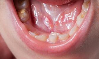 A permanent molar in a child grows second row. Incorrect growth of molars or polyodontia in dentistry, close-up photo