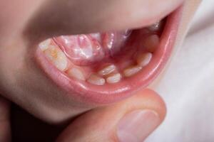 A permanent molar in a child grows second row. Incorrect growth of molars or polyodontia in dentistry, close-up photo