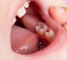 Installation of a colored red filling in a milk tooth for a child. Colored fillings in dentistry for children. Treatment of pulpitis and deep caries, close-up photo