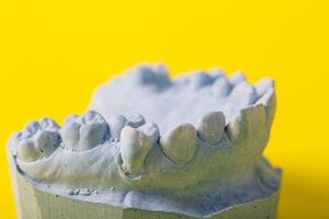 Blue plaster model of an impression of a patient's jaw at an orthodontist dentist on a yellow background. Manufacturing of dentures and crowns for dental prosthetics in orthodontics, macro. photo