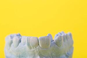 Blue plaster model of an impression of a patient's jaw at an orthodontist dentist on a yellow background. Manufacturing of dentures and crowns for dental prosthetics in orthodontics, macro. photo