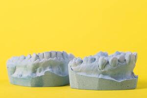 Blue plaster impression of a patient's dental jaw with crooked teeth and malocclusions on a yellow background. Manufacturing of bridges, crowns of various types, macro. Copy space for text photo