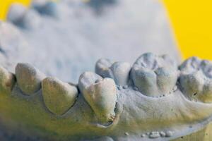 Blue plaster model of an impression of a patient s jaw at an orthodontist s dentist, close-up. Crooked teeth, correction of malocclusion, macro photo