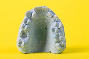 Blue plaster impression of a patient's dental jaw with crooked teeth and malocclusions on a yellow background. Manufacturing of braces to correct bite. View from above. Copy space for text photo