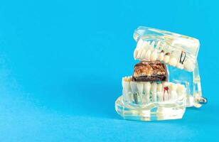 A bitten chocolate bar in a dental jaw mockup on a blue background. The concept of sweets harming tooth enamel, caries. Copy space for text photo