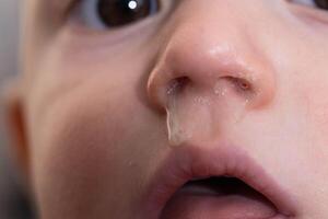 Yellow snot from a child s nose, close-up. Sinus infections, colds and virus. Chronic runny nose, adenoviruses photo