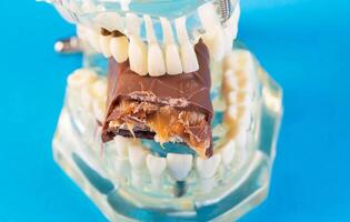 A bitten piece of chocolate in a dental jaw mockup on a blue background. The concept of the effect of sugar and leftover food on teeth and tooth enamel. Tooth destruction by bacteria photo