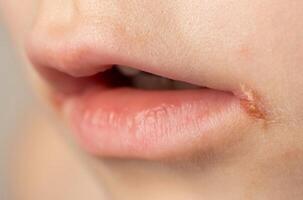 Seizures on the corners of the lips of a child s mouth. Bacterial disease of inflammation of the corners of the lips. Angular stomatitis with reduced immunity in a child, macro photo
