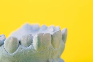 Blue plaster model of an impression of a patient's jaw at an orthodontist dentist on a yellow background. Manufacturing of dentures and crowns for dental prosthetics in orthodontics, macro. photo