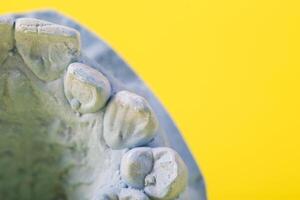 Blue plaster impression of a patient's dental jaw with crooked teeth and malocclusions on a yellow background. Manufacturing of braces to correct bite. View from above. Copy space for text photo