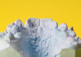 Blue plaster impression of a patient's dental jaw with crooked teeth and malocclusions on a yellow background. Manufacturing of braces to correct bite. View from above. Copy space for text photo