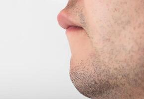 A man has a large upper lip, close-up. Reduction and correction of lips using plastic surgery, cheiloplasty photo