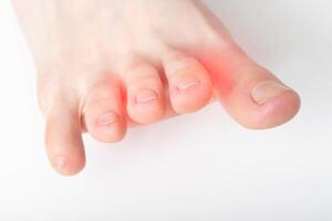 A crooked and stiff toe on a white background. Interdigital neuralgia, macro, copy space for text photo