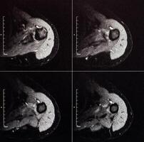 MRI image of the shoulder joint after a fracture and dislocation. Impression fracture of the humeral head. Damage to the joint capsule, joint deformation, arthrosis, close-up photo