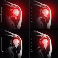 MRI image of the shoulder joint after a fracture and dislocation. Impression fracture of the humeral head. Shoulder injury, sprain, synovitis. The redness and inflammation are red on the MRI image. photo