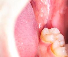 recess after complex impacted wisdom tooth extraction, traumatic healing. Dry socket, alveolitis, macro. Copy space for text photo